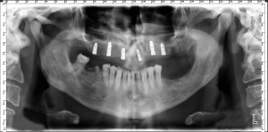 Implantologie - Dr. Dumitriu Dental Clinic