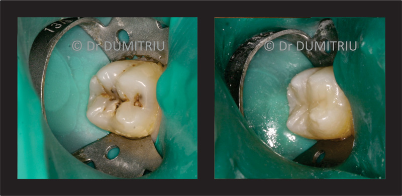 Plombe - Dr. Dumitriu Dental Clinic